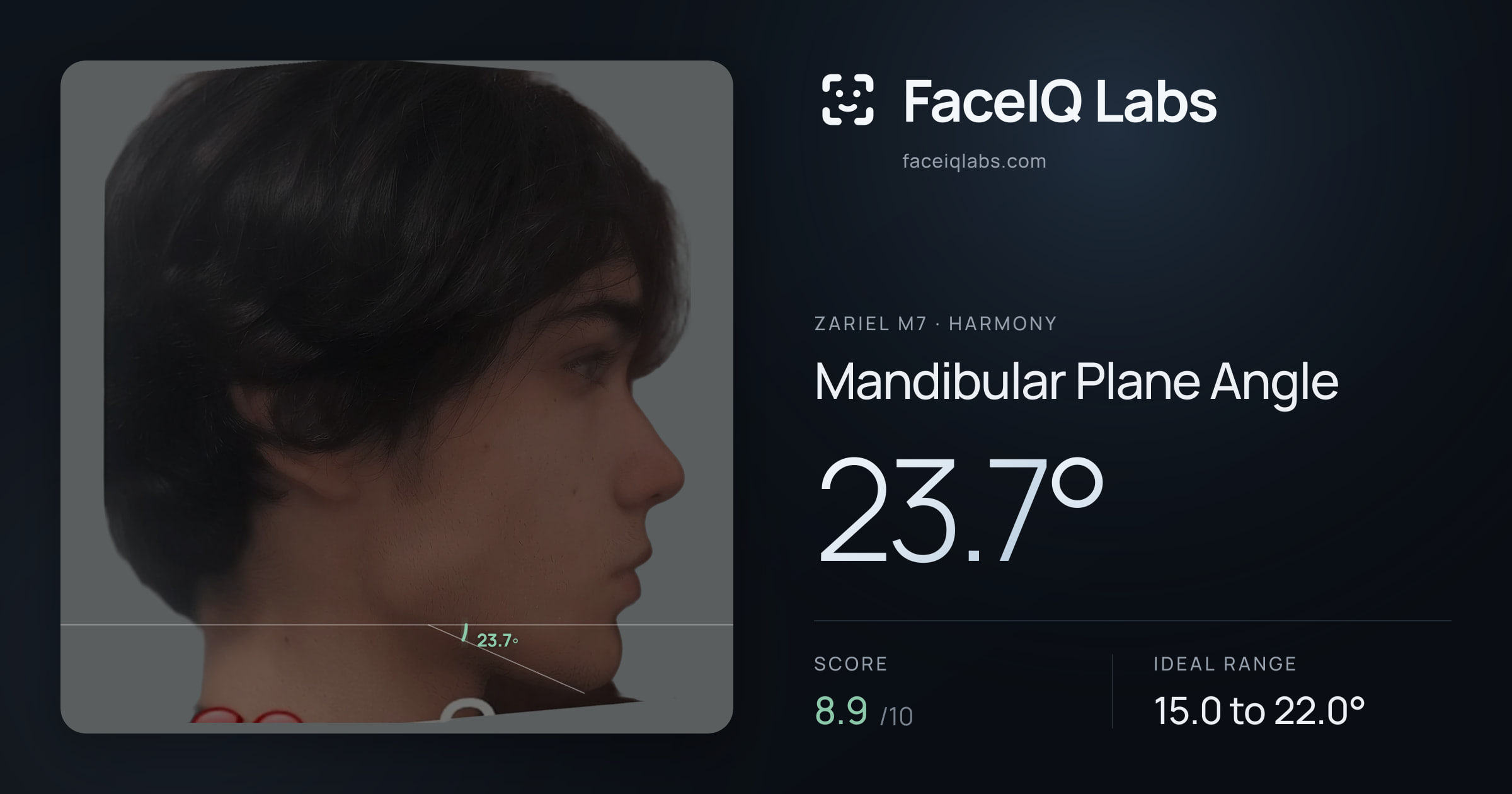 Zariel M7 Mandibular Plane Angle: 23.7°, drawn on the photo