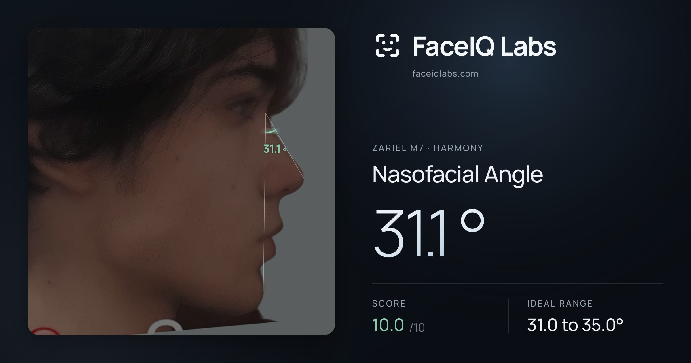 Zariel M7 Nasofacial Angle: 31.1°, drawn on the photo