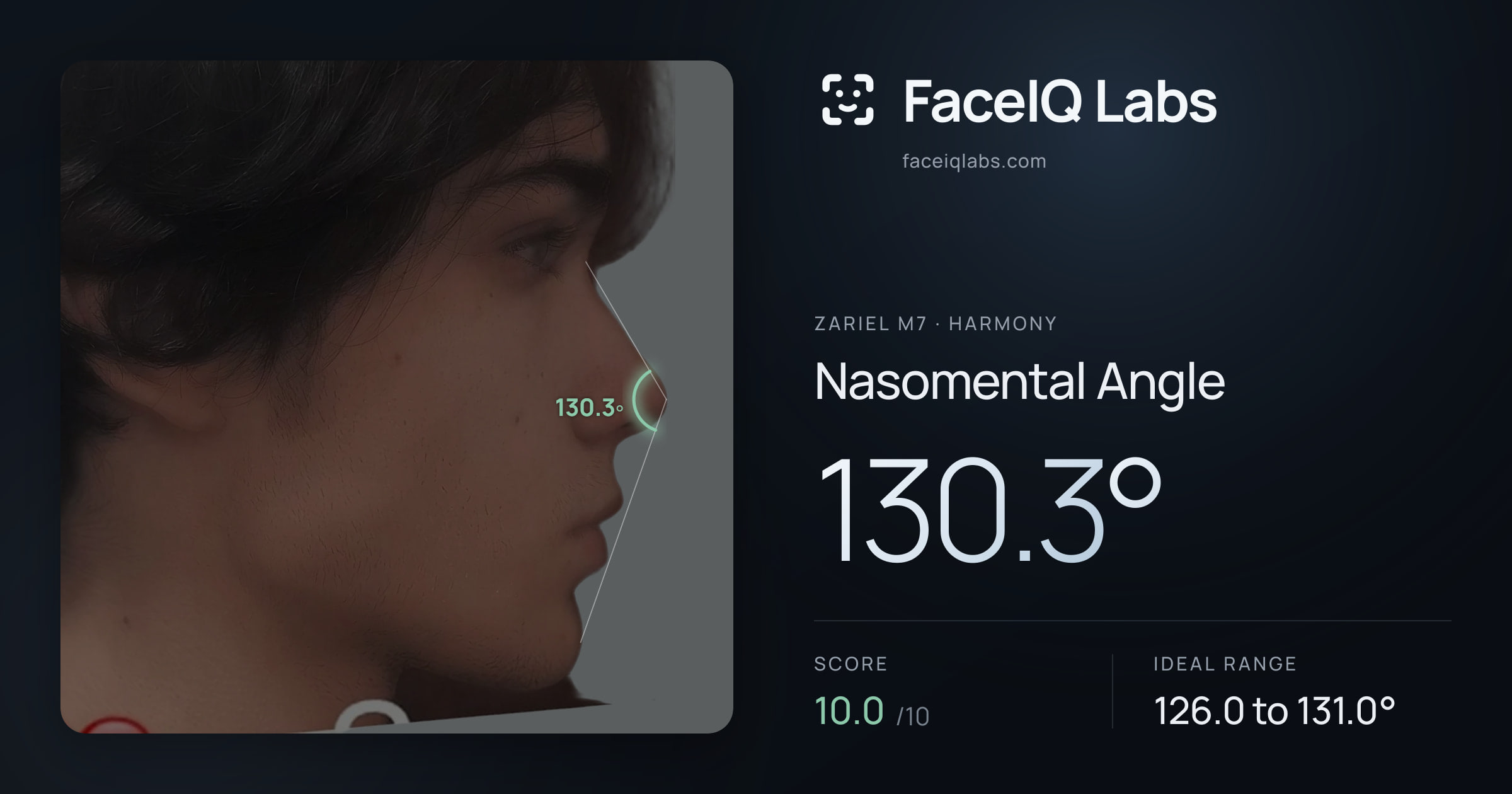Zariel M7 Nasomental Angle: 130.3°, drawn on the photo