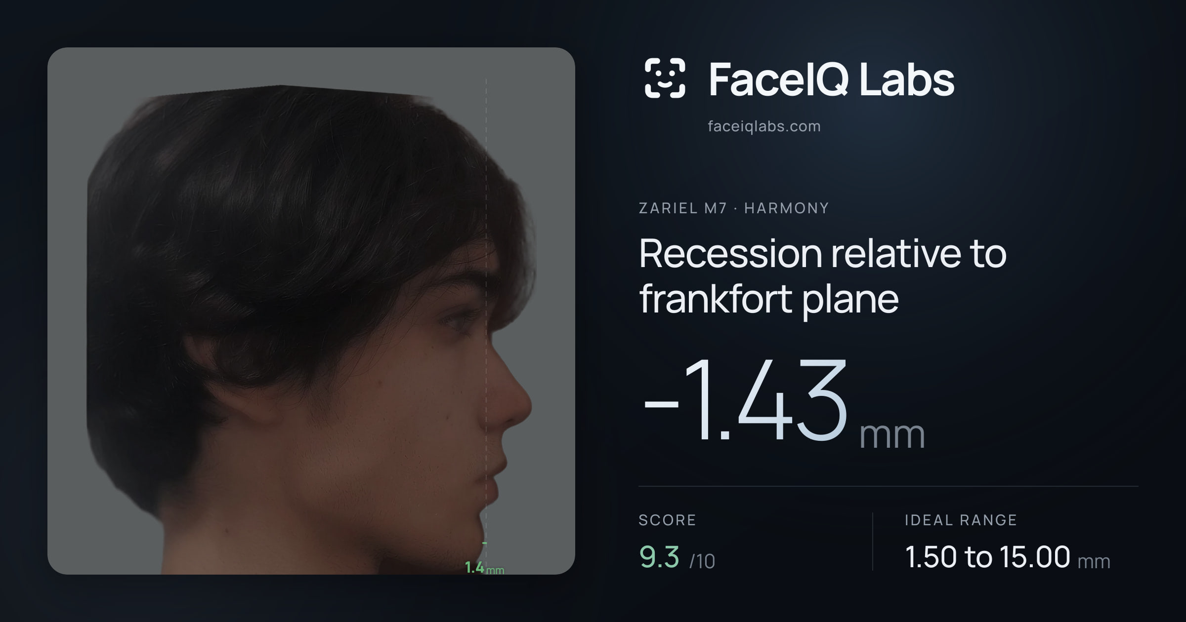 Zariel M7 Recession relative to frankfort plane: -1.43mm, drawn on the photo