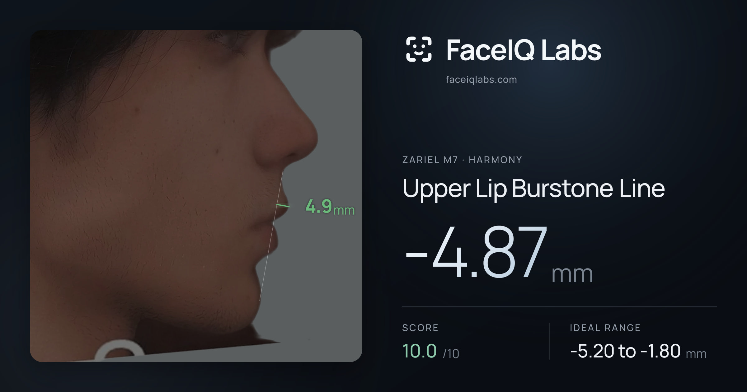 Zariel M7 Upper Lip Burstone Line: -4.87mm, drawn on the photo