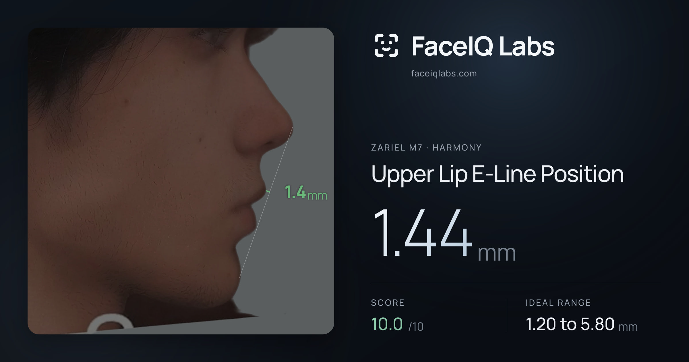 Zariel M7 Upper Lip E-Line Position: 1.44mm, drawn on the photo