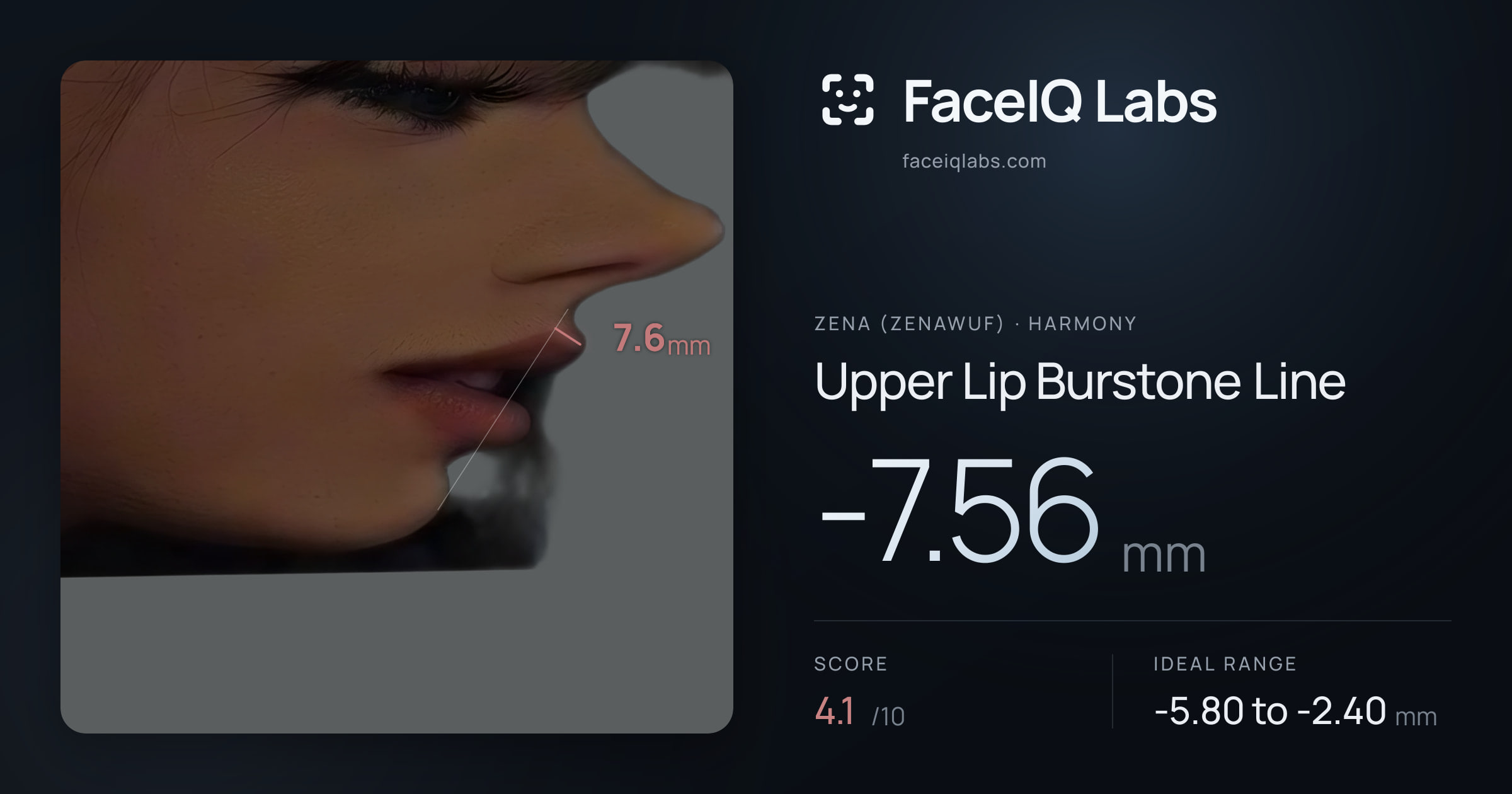 Zena (Zenawuf) Upper Lip Burstone Line: -7.56mm, drawn on the photo