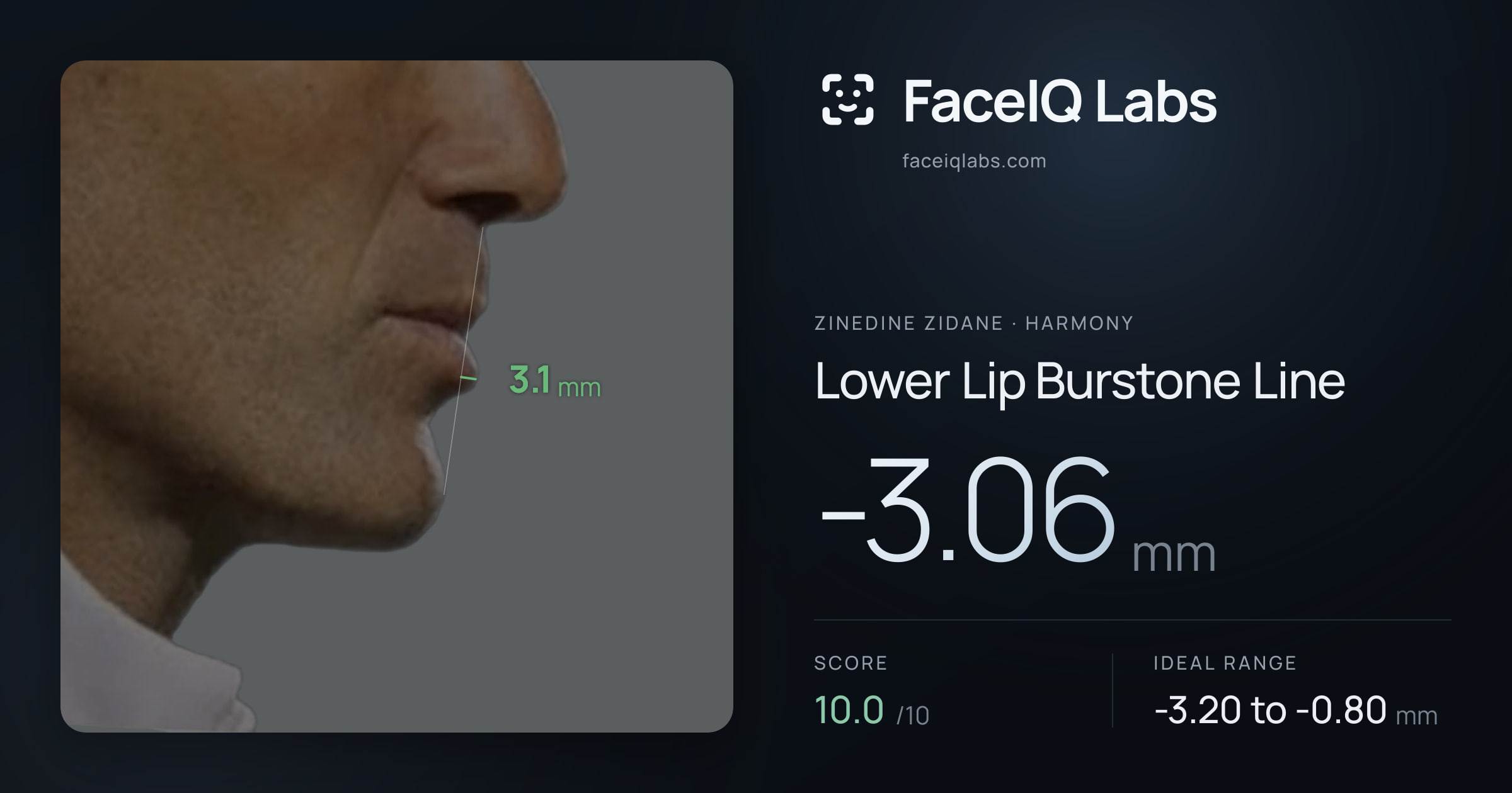 Zinedine Zidane Lower Lip Burstone Line: -3.06mm, drawn on the photo