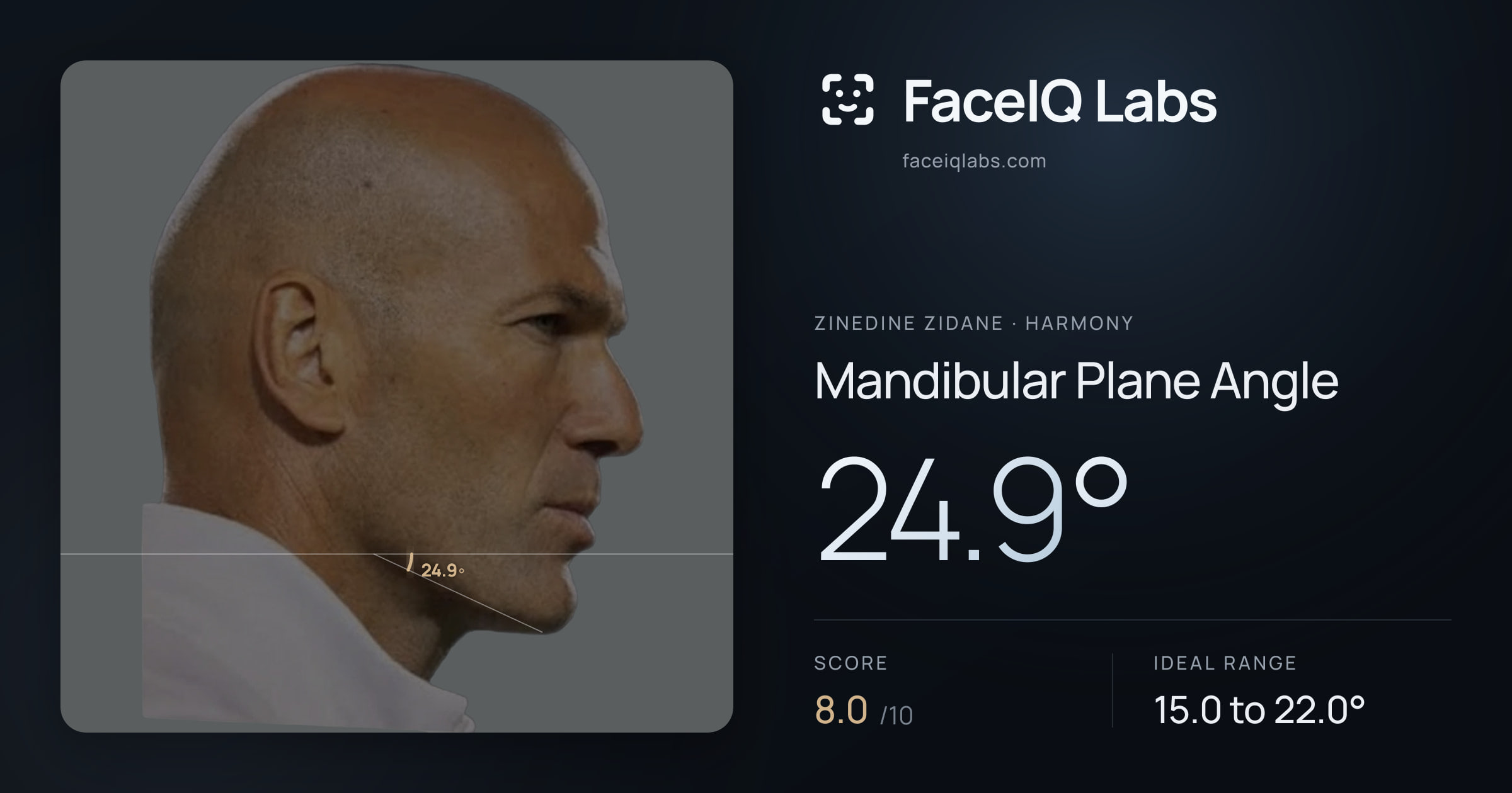 Zinedine Zidane Mandibular Plane Angle: 24.9°, drawn on the photo