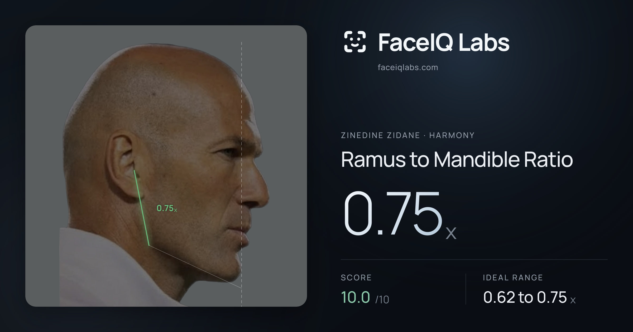 Zinedine Zidane Ramus to Mandible Ratio: 0.75x, drawn on the photo