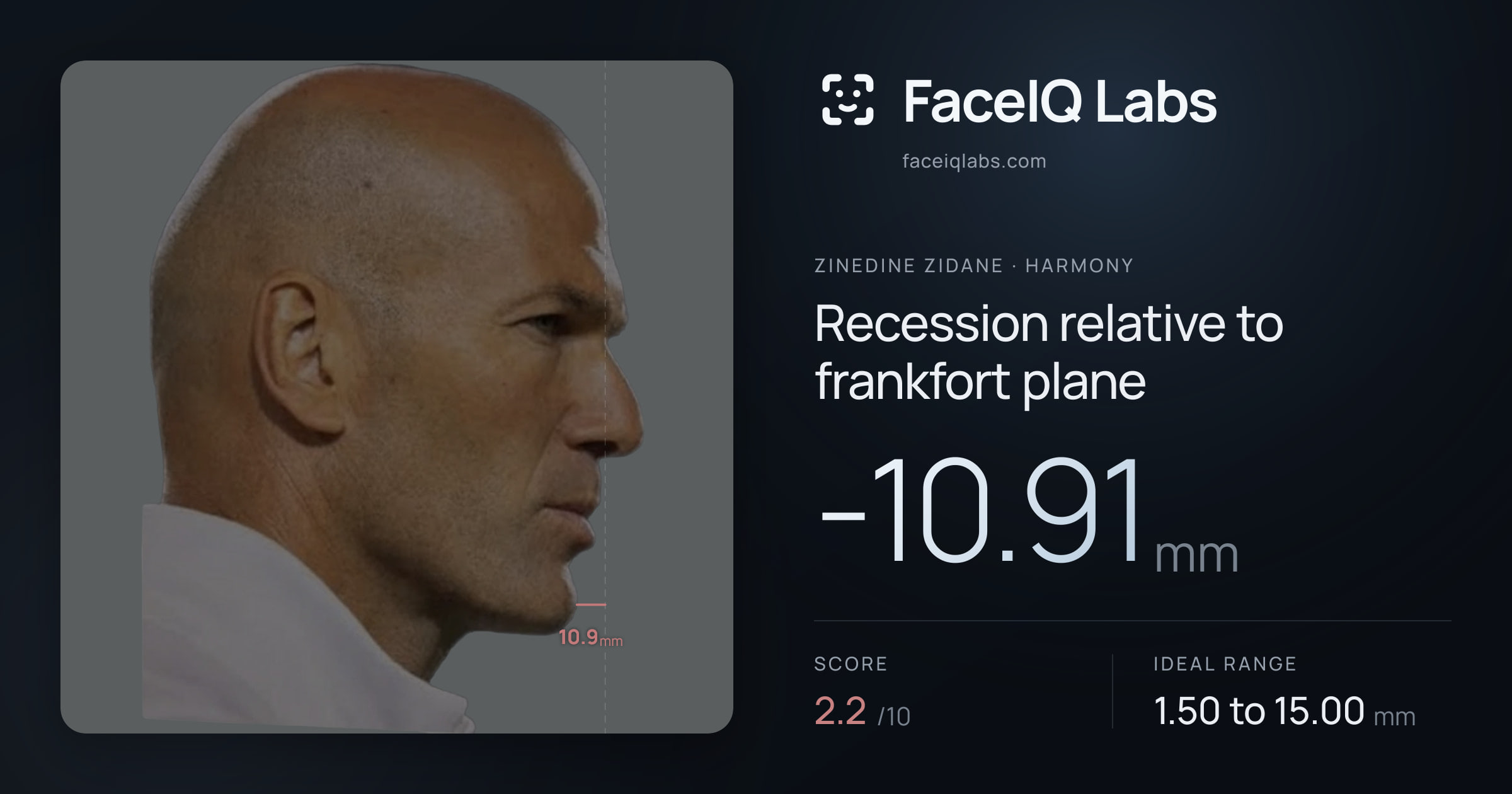 Zinedine Zidane Recession relative to frankfort plane: -10.91mm, drawn on the photo