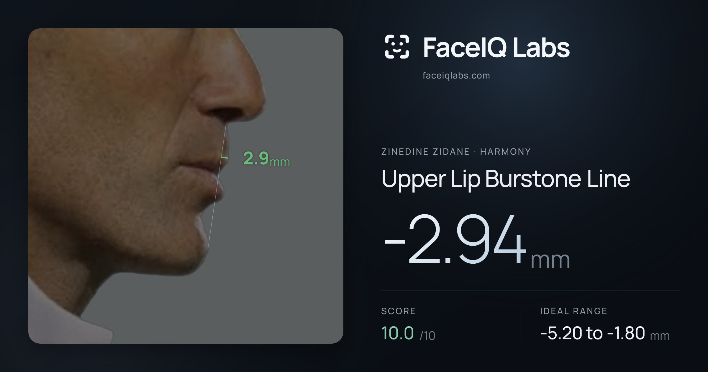 Zinedine Zidane Upper Lip Burstone Line: -2.94mm, drawn on the photo